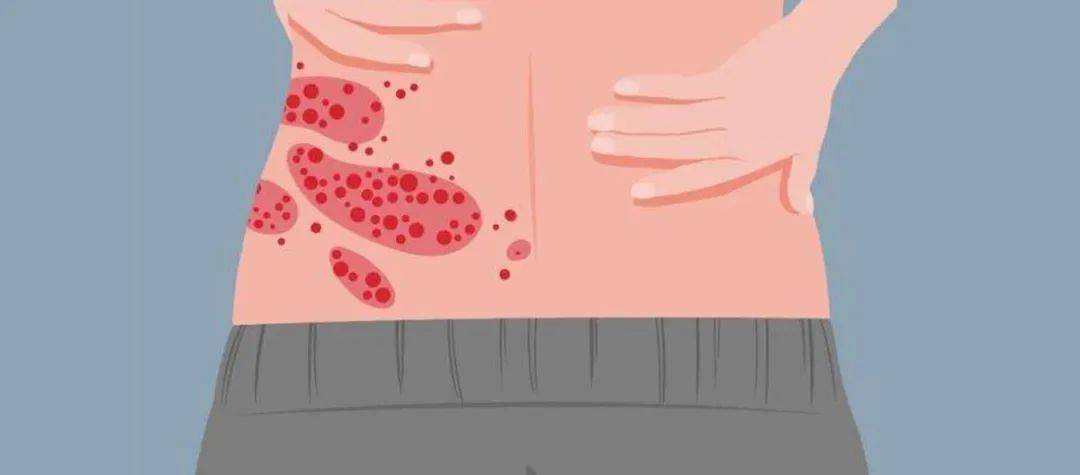 一旦感染终身携带<strong></p>
<p>打制币</strong>!深圳疾控提醒:这4类人要注意