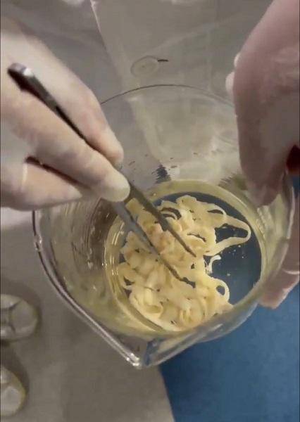 女子体内排出10米长绦虫<strong></p>
<p>职业炒币</strong>!原是两年前旅游时吃了这种食物