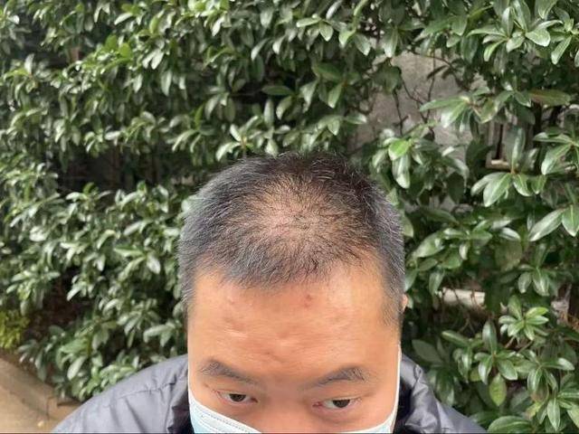 “还能反光<strong></p>
<p>坐以待币</strong>!”长沙男子植发近9月称后脑勺“像狗啃过”