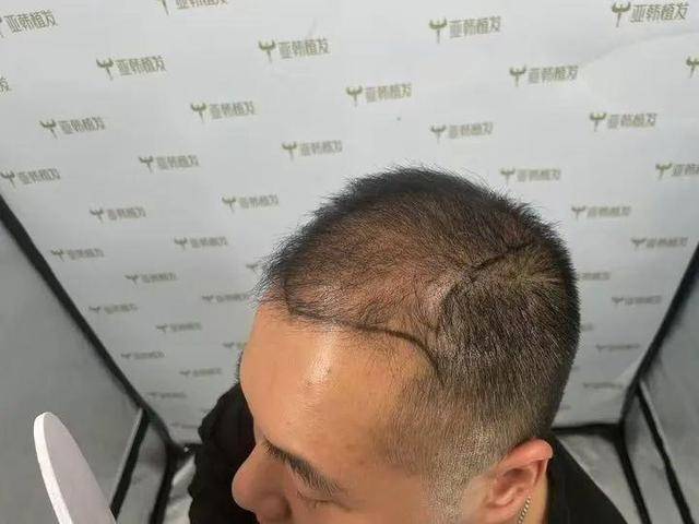 “还能反光<strong></p>
<p>坐以待币</strong>!”长沙男子植发近9月称后脑勺“像狗啃过”