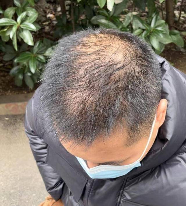 “还能反光<strong></p>
<p>坐以待币</strong>!”长沙男子植发近9月称后脑勺“像狗啃过”