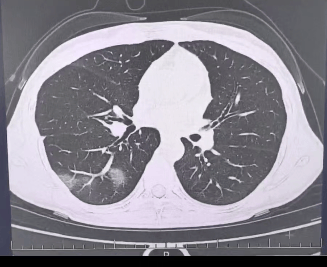 查出流感没在意<strong></p>
<p>币圈情况</strong>,女子硬扛三天后肺都“白”了……