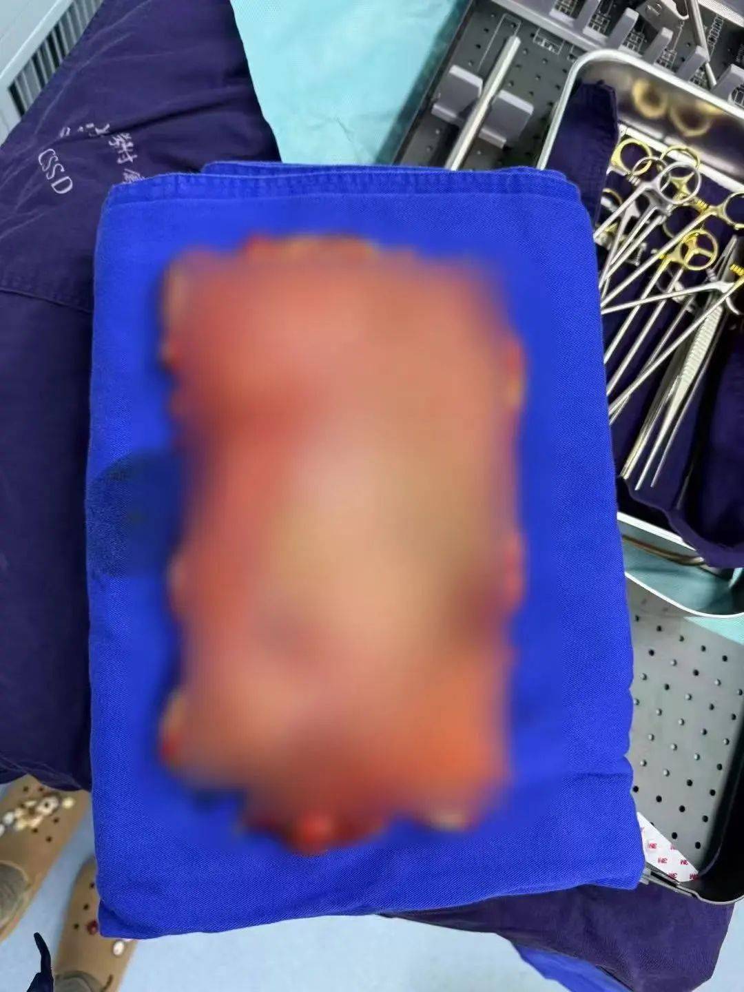 女子多器官衰竭、整个胃被摘除<strong></p>
<p>币圈情况</strong>，医生清理出10斤……紧急提醒