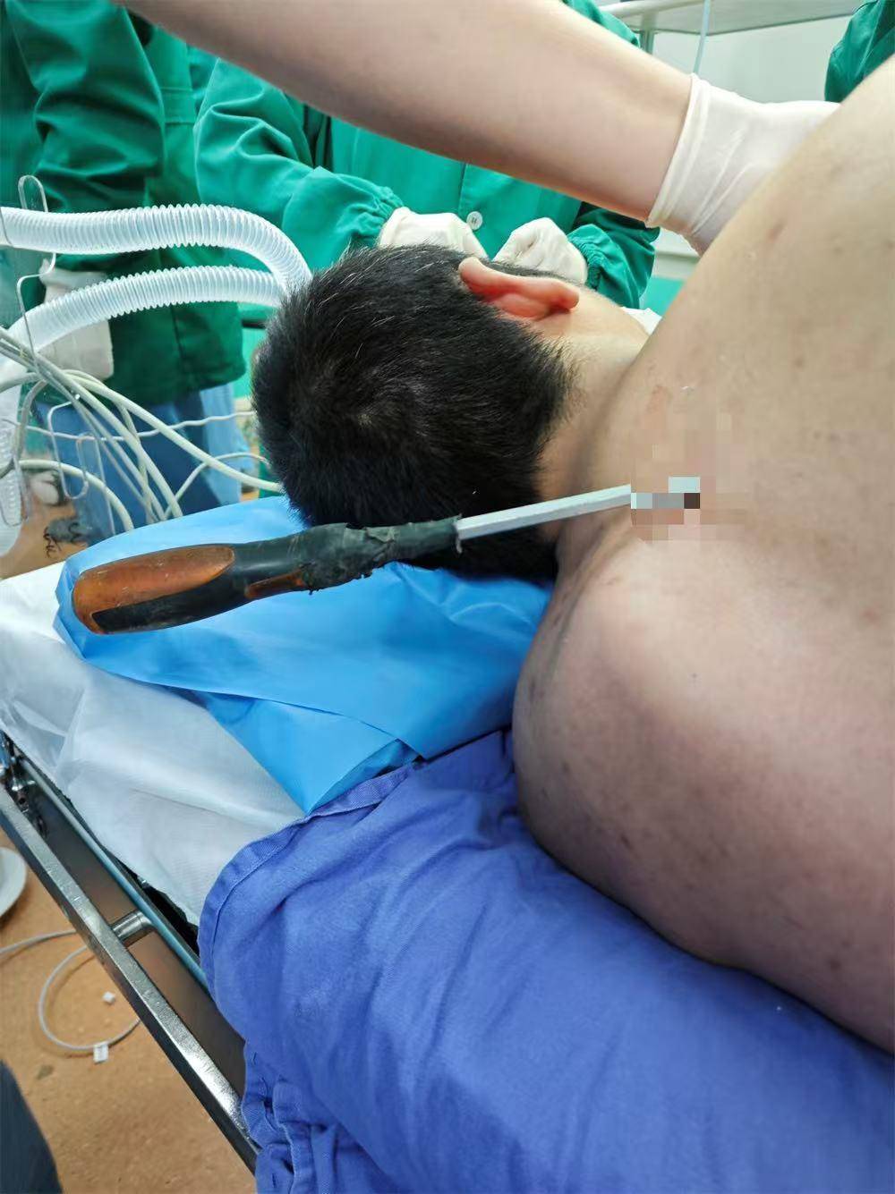 20米高空掉落螺丝刀直插男子胸腔<strong></p>
<p>炒币秘籍</strong>!医生:不要自行拔除