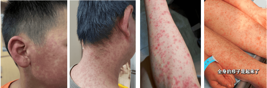 超6000例<strong></p>
<p>btx币</strong>！仍在新增！或发展成慢性病及有后遗症！上海华山医院：这些驱蚊产品没用！