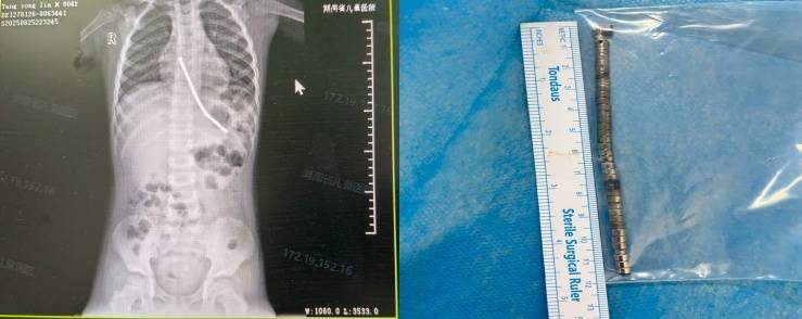 整整40颗<strong></p>
<p>炒币子</strong>!湖南3岁男童身体里取出……医生紧急提醒