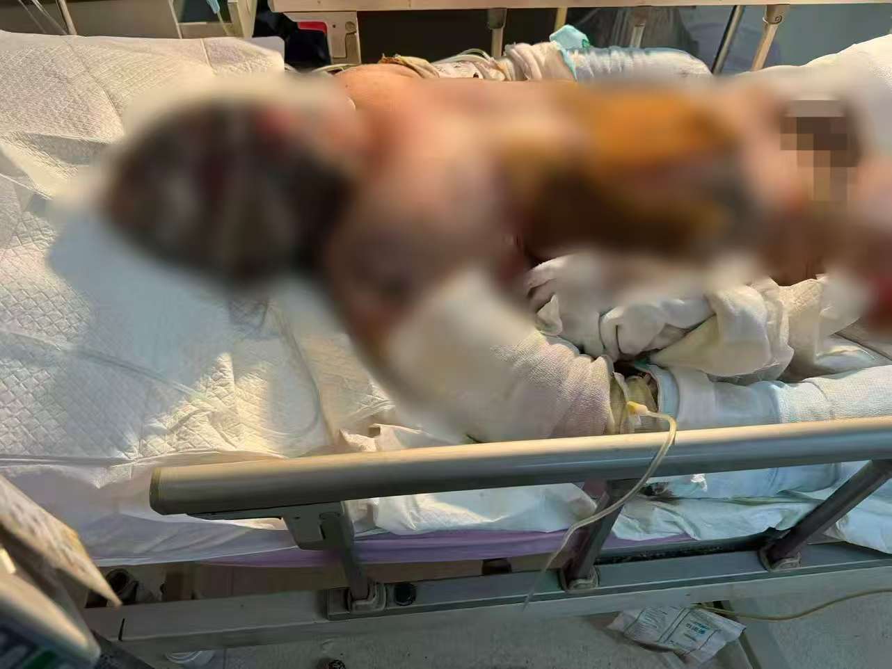 父子在哈尔滨一亲戚公司上班遇爆炸全身烧伤<strong></p>
<p>吹牛币</strong>，治疗花费近百万公司拒赔偿？亲戚回应