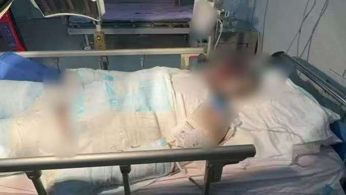 父子在哈尔滨一亲戚公司上班遇爆炸全身烧伤<strong></p>
<p>吹牛币</strong>，治疗花费近百万公司拒赔偿？亲戚回应