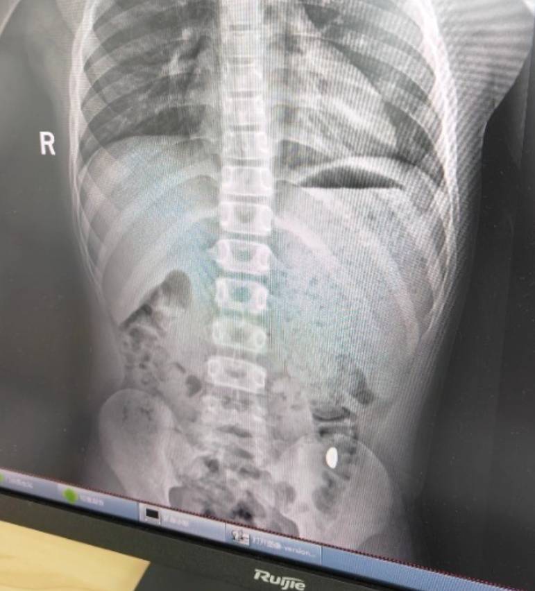 “熊孩子”误吞10克重金豆<strong></p>
<p>币圈神话</strong>，妈妈：天天叮嘱他不要在外面拉屎