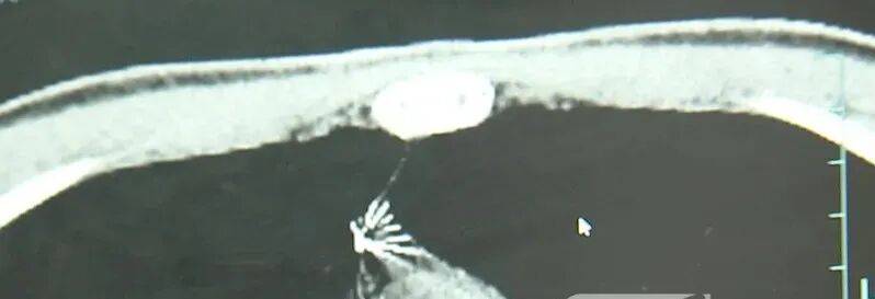 17岁小伙参军体检发现胸腔内有根5cm缝衣针<strong></p>
<p>币圈社区介绍</strong>，父母回忆或是1岁时扎入，取出时已锈迹斑斑